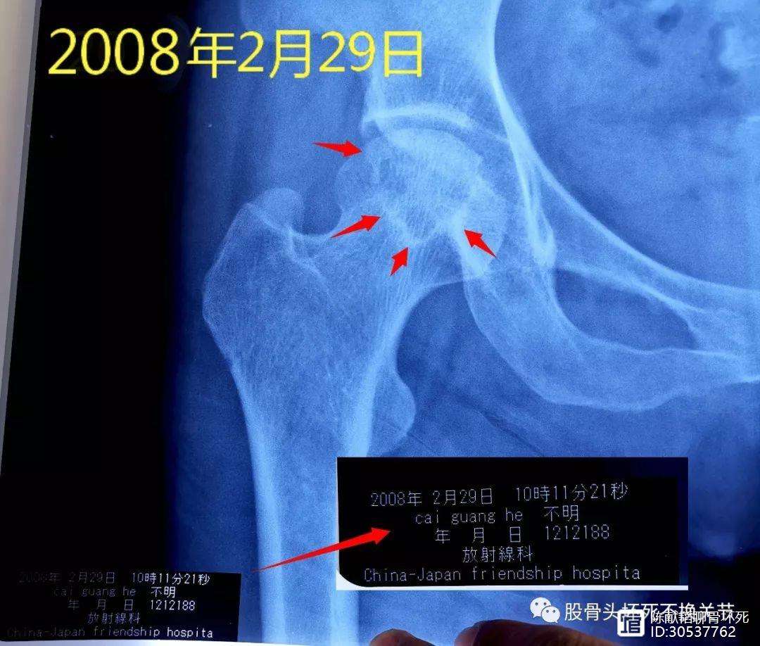 百色人工骨头医保报销多少(人工骨头医保报销多少比例)
